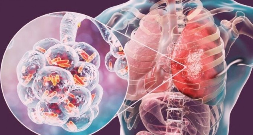 Tuberculosis: entre 2020 y  2025 los casos aumentaron un 65%