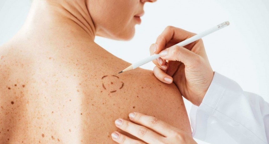 Día Mundial del Melanoma: La clave es prevenir y concientizar